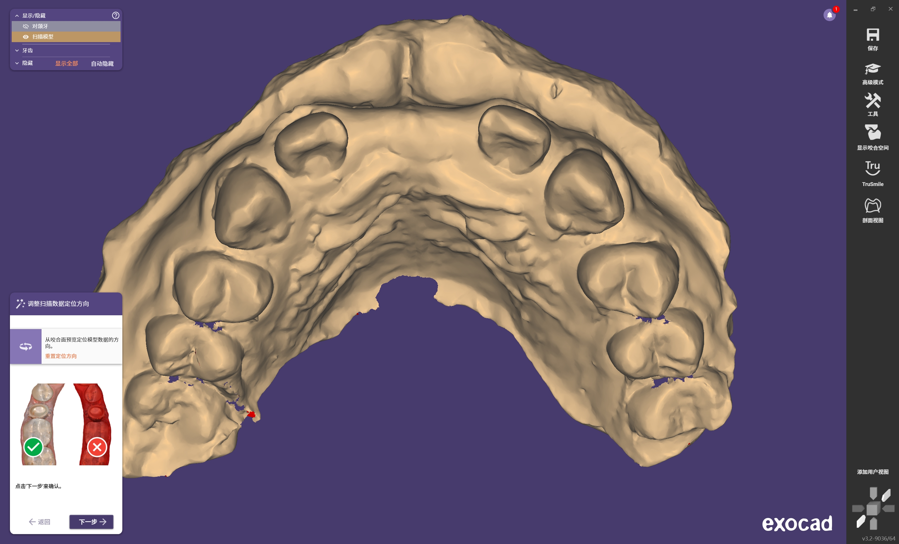 弹性义齿解决方案 | HeyGears Dental Wiki