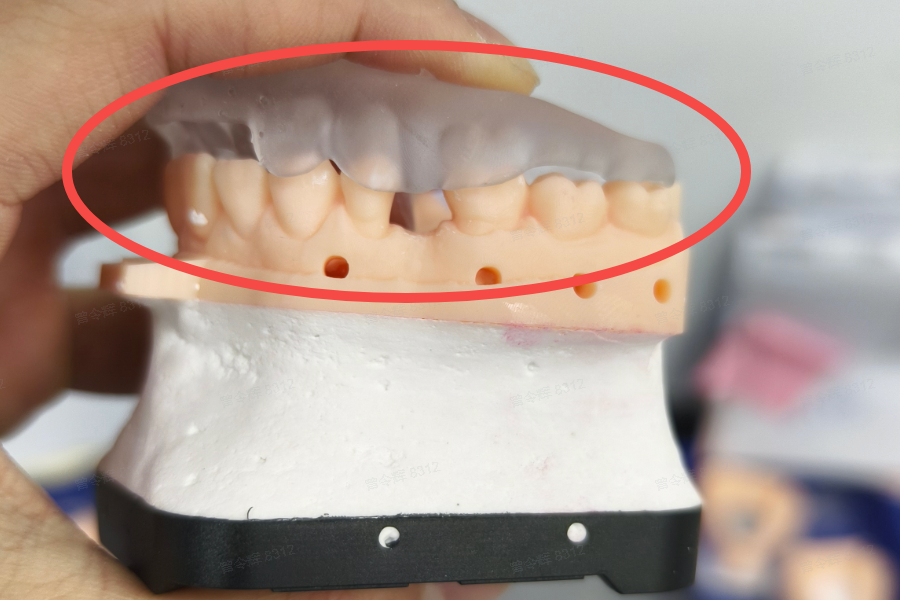 Splint Q&A | HeyGears Dental Wiki